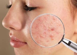 Fungal Acne