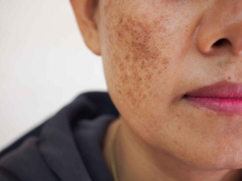 skin-pigmentation